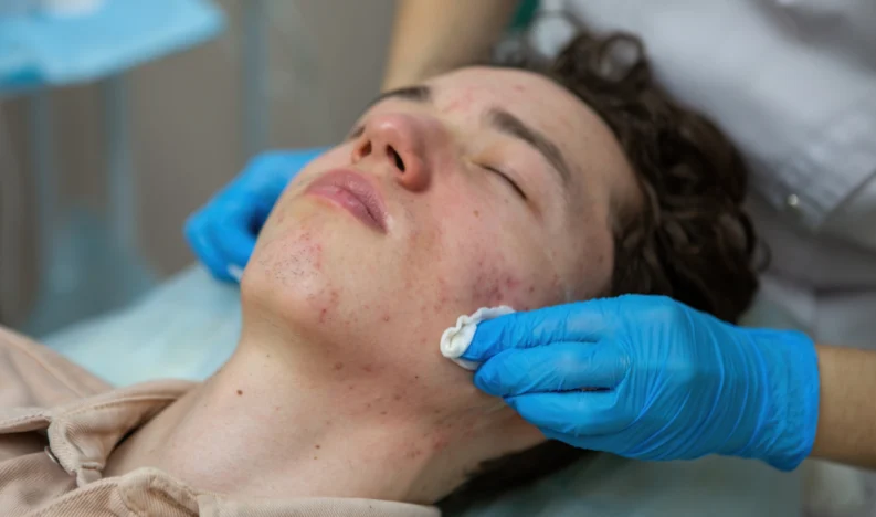Acne Management, Including Roaccutane Therapy