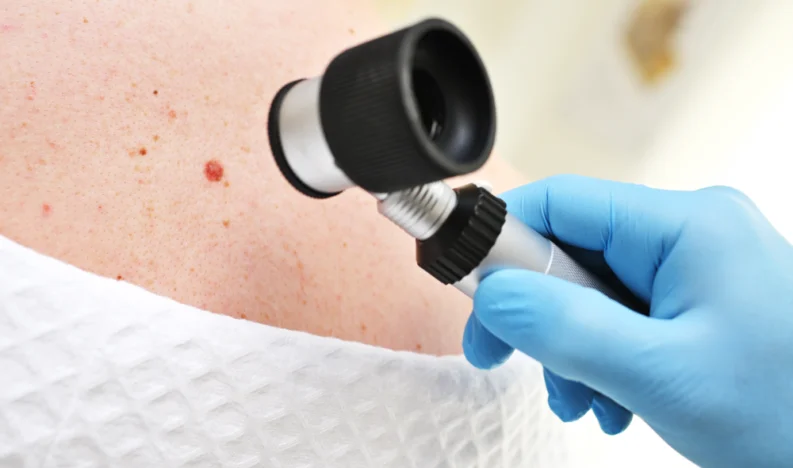 Skin Cancer Excisions